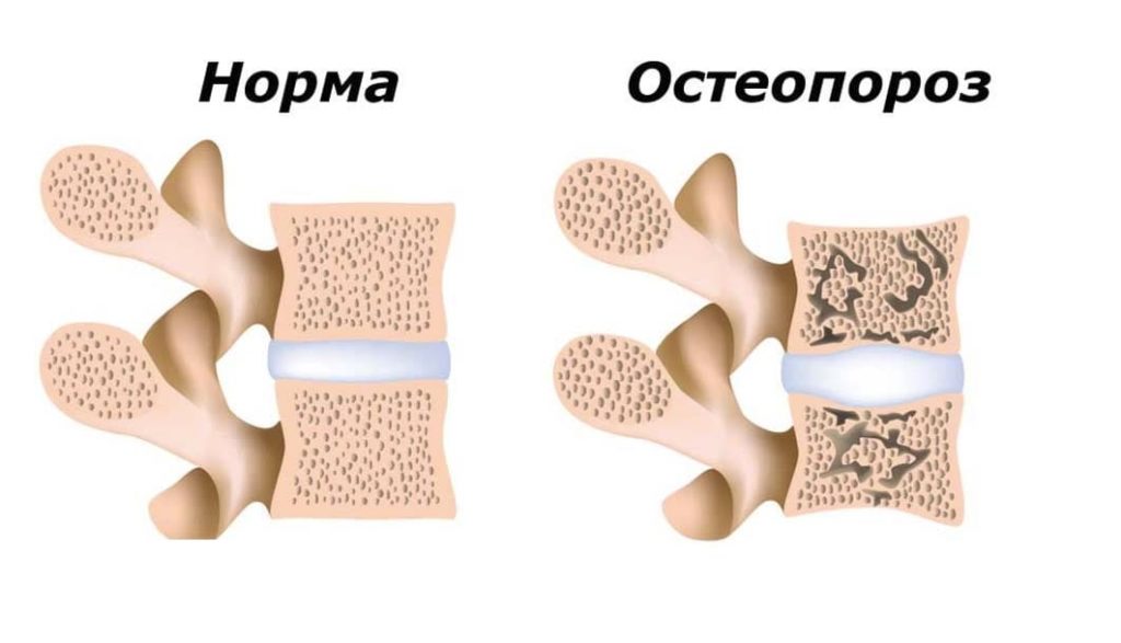 остеопороз костных тканей