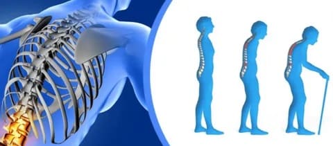 остеопороз костных тканей в основном у людей в возрасте