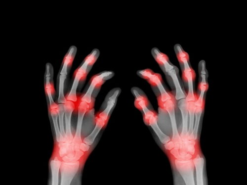 деформирующий остеоартроз кистей рук