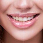Как безопасно отбелить зубы в домашних условиях